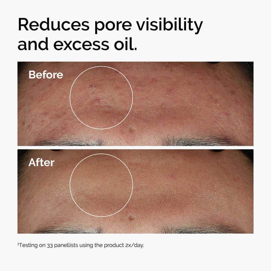 niacinamide-10-zinc-1-t2 ord-niacinamide-zinc-blemish-serum-before-after-pores.jpg