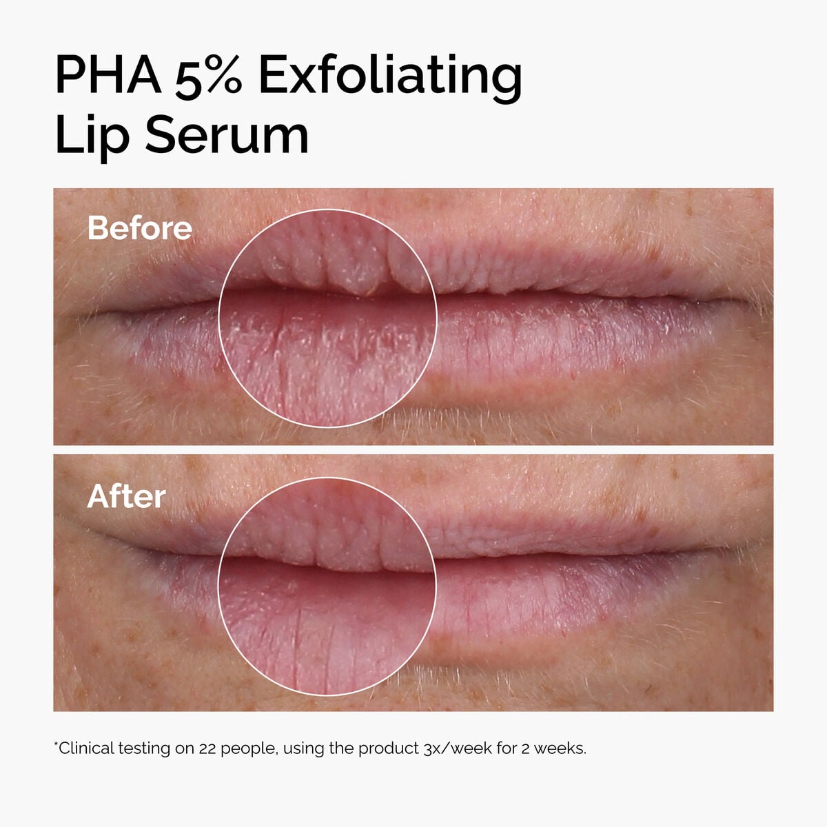 pha-5-exfoliating-lip-serum-p5 ord-pha-5pct-lip-exfoliating-serum-before-after.jpg