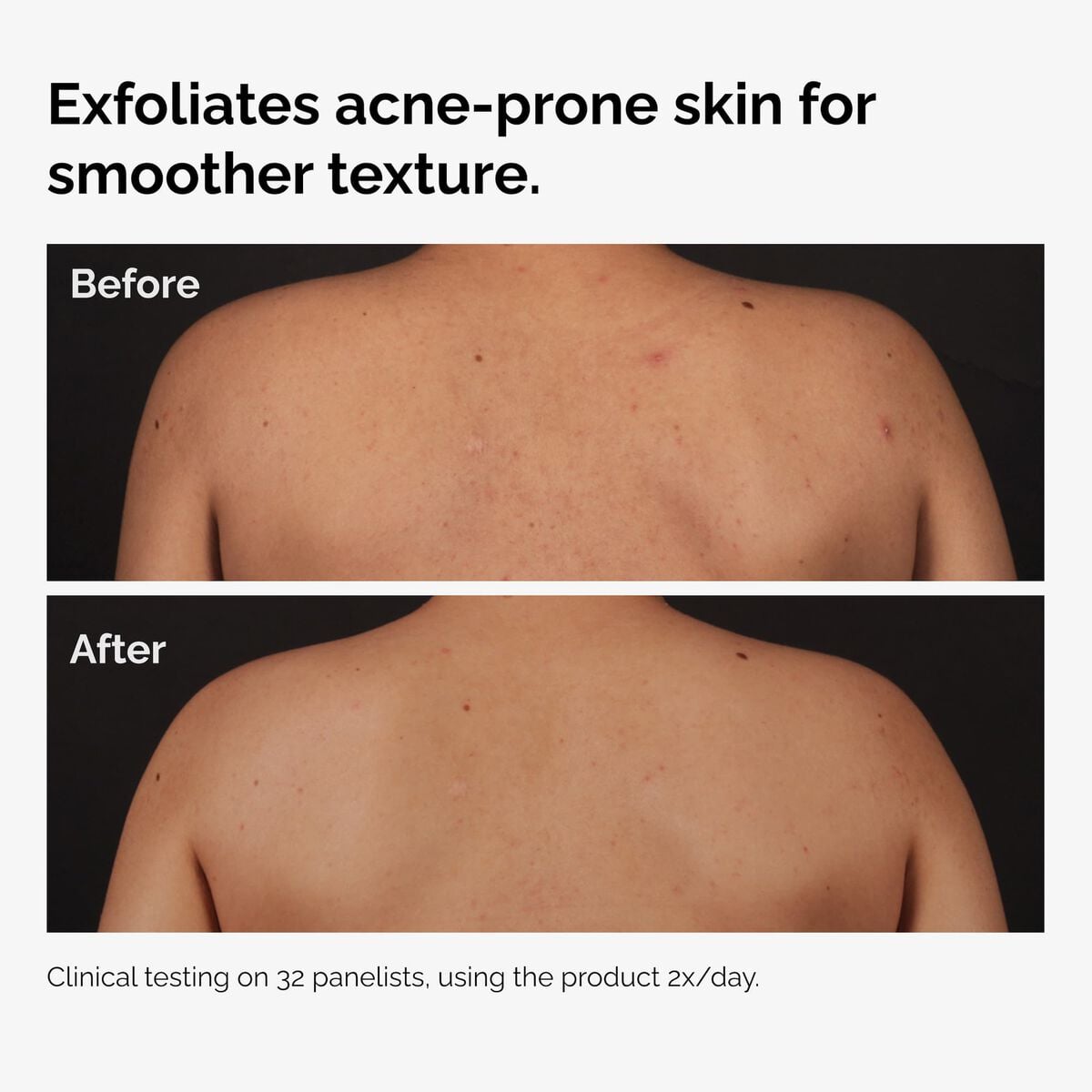 salicylic-acid-0-5-body-serum-j1 ord-salicylic-acid-body-serum-before-after-graphic-NA.jpg