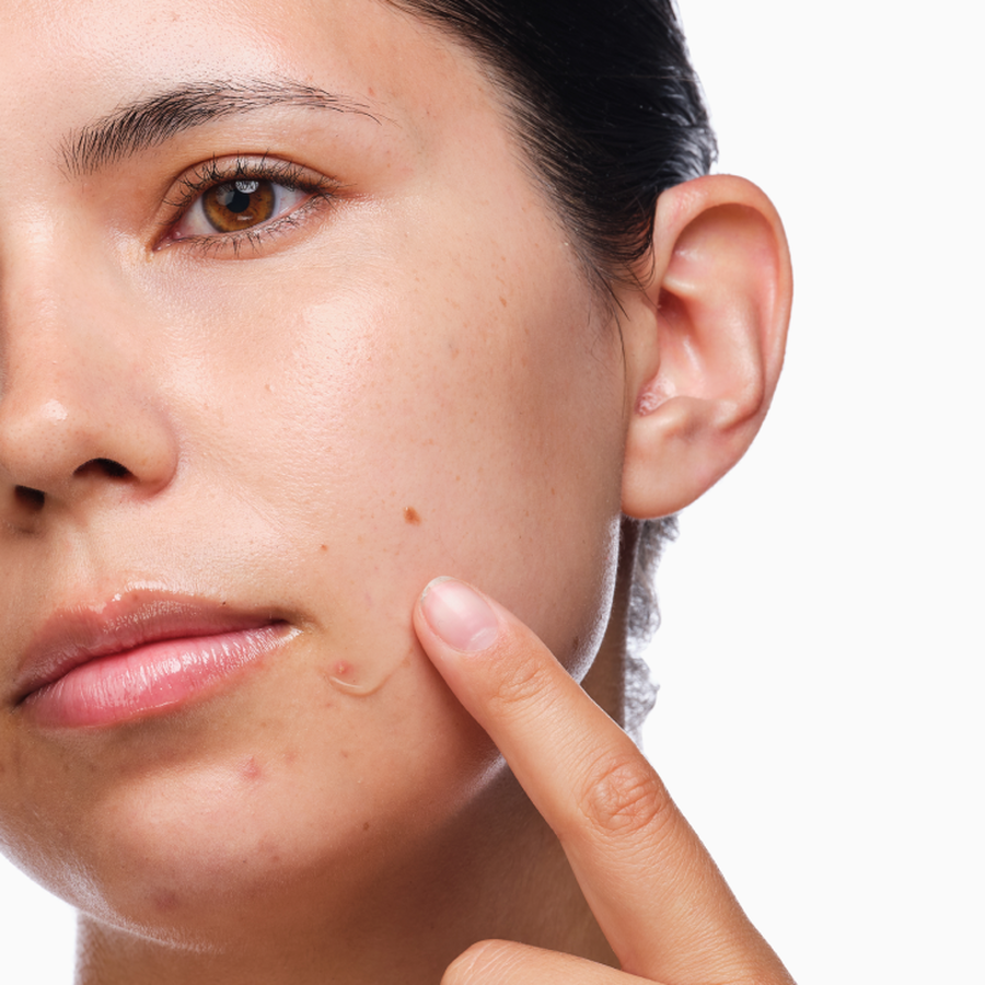 the-acne-set-r0 rdn-the-acne-set-application.png